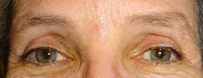 After Blepharoplasty