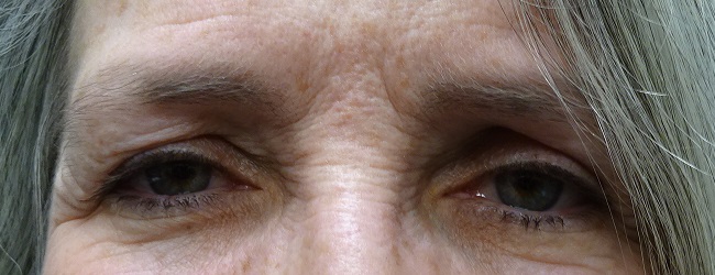 Before Blepharoplasty