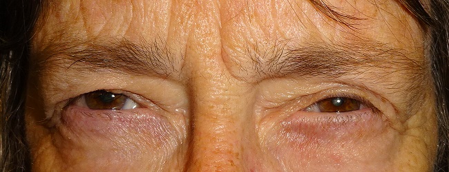 Before Blepharoplasty